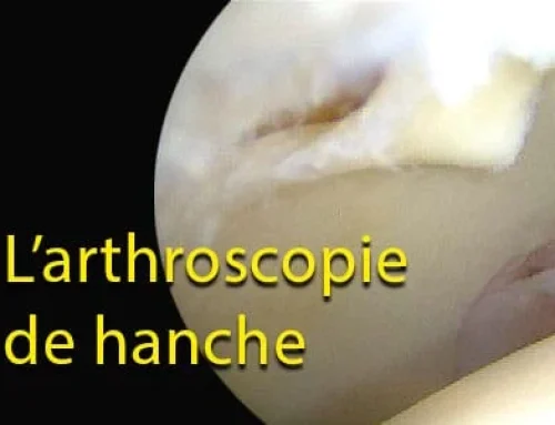 L&rsquo;arthroscopie de hanche