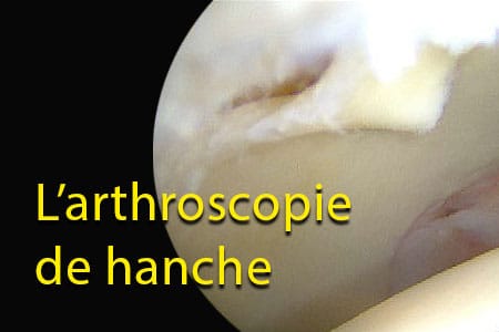 arthroscopie-de-hanche