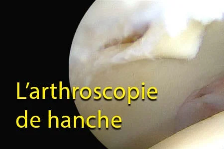 L&rsquo;arthroscopie de hanche