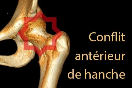 Conflit antérieur de hanche
