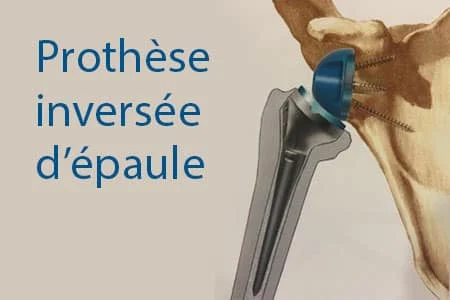 Prothèse inversée d&rsquo;épaule