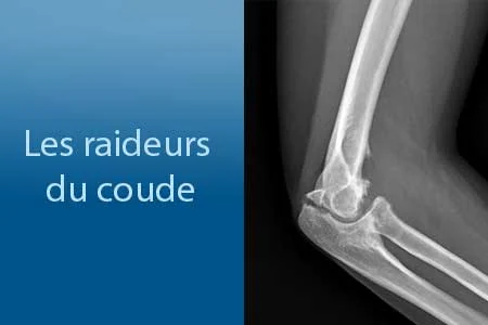 Les raideurs du coude
