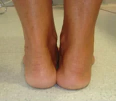 Le Tendon d’Achille