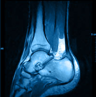 IRM d'une rupture partielle du tendon d'Achille