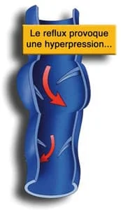 varices-2 varices-03