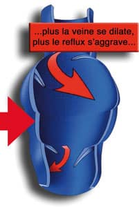 varices-4 varices-4