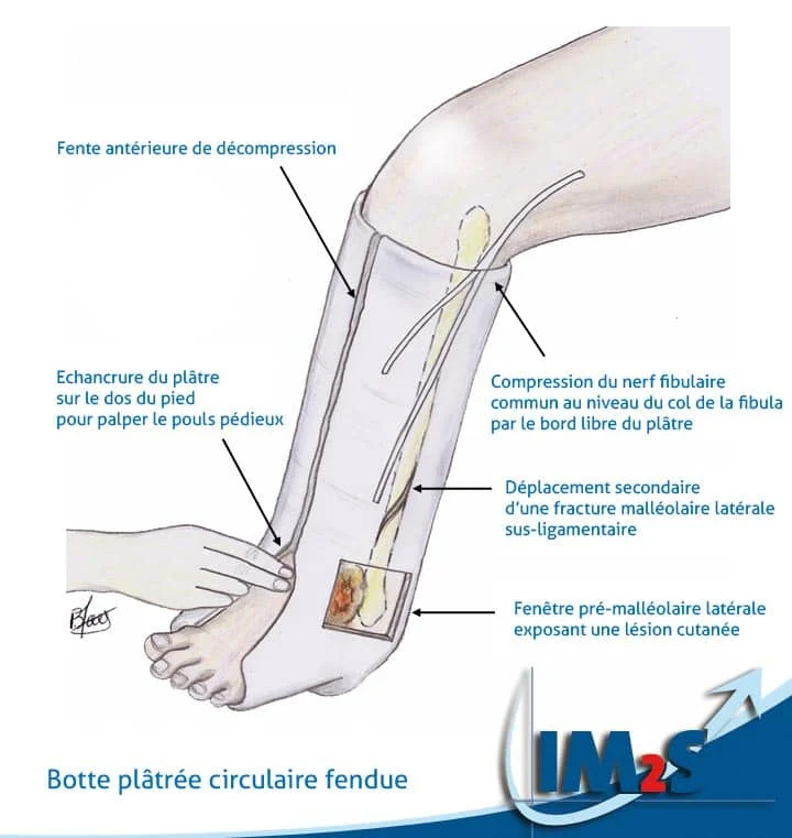 botte-platree