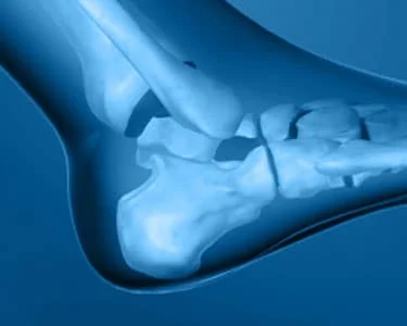 Arthrose de la cheville