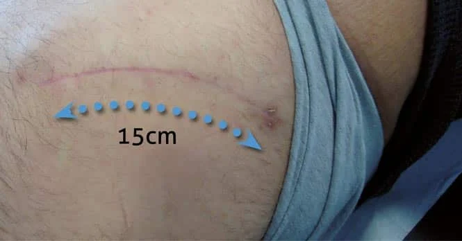 Cicatrice après resurfaçage
