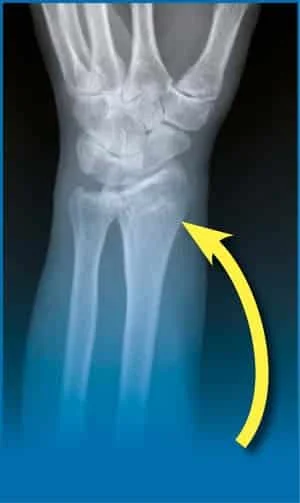 Fracture du poignet