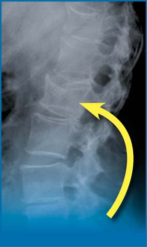osteoporose-tassement-vertebre