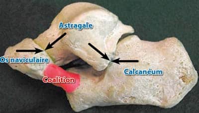 bec-calcaneen