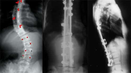 chirurgie-scoliose-enfant