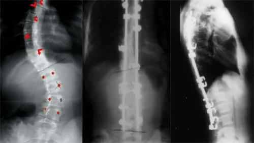 chirurgie-scoliose-enfant