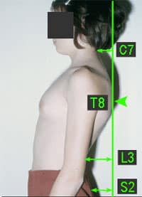 scoliose-enfant-1 scoliose enfant