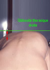 scoliose-enfant-3 scoliose enfant