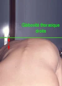 scoliose-enfant-3 scoliose enfant