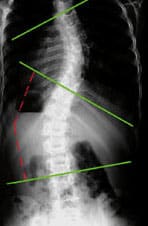 scoliose-enfant-4 scoliose-enfant-4