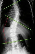 scoliose-enfant-4 scoliose-enfant-4