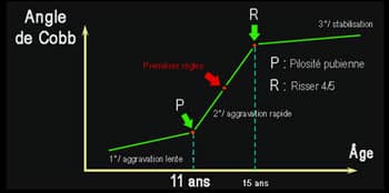 scoliose-enfant-5