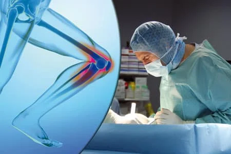 dr-schlatterer-genou L’IM2S en pointe sur le genou
