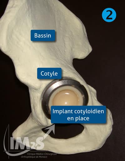 prothese-de-hanche