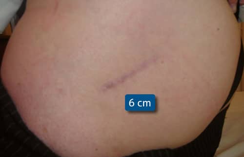 prothese-de-hanche-cicatrice prothese-de-hanche-cicatrice