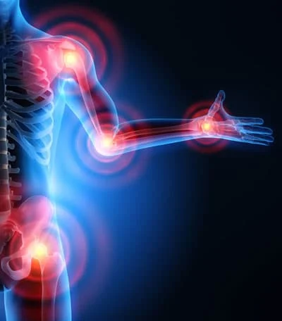 Pour que l&rsquo;arthrose ne soit plus une fatalité