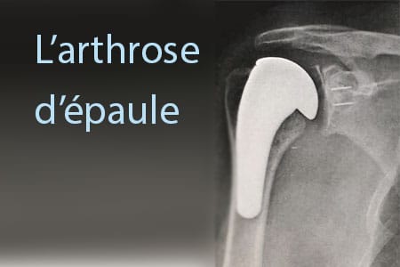 arthrose-epaule