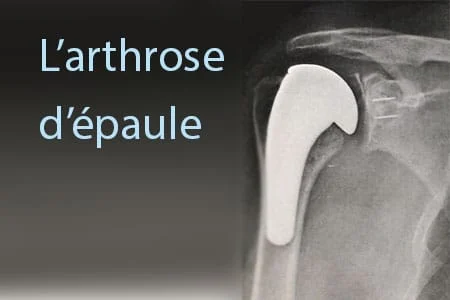 L’arthrose d’épaule