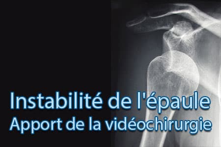 thumb-instabilite-epaule