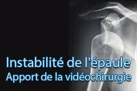 Instabilité de l&rsquo;épaule
