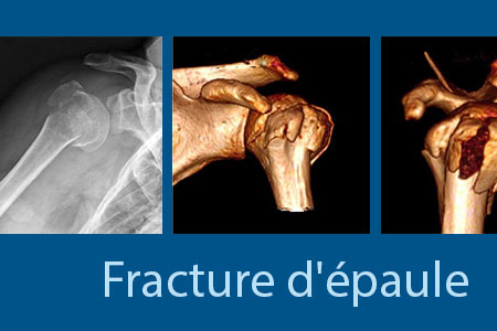 thumb-fracture-epaule