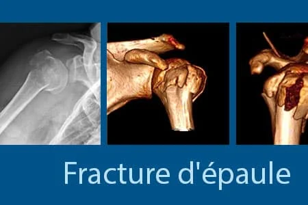 Fracture d’épaule