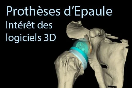 Planification pré-opératoire des prothèses d’épaule