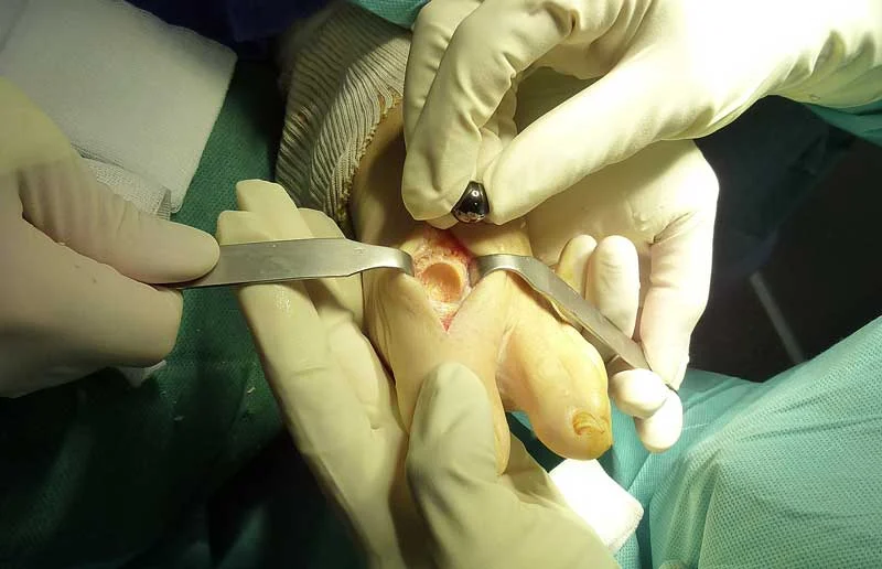 arthrose-gros-orteil-pyrocarbone-dr-maestro