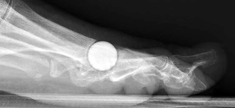 arthrose-gros-orteil-pyrocarbone-dr-maestro