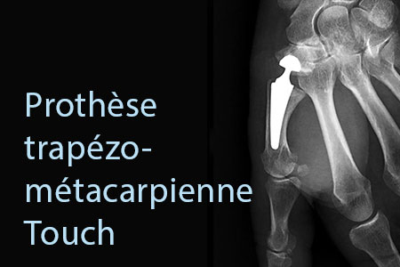 thumb-prothese-trapezo-metacarpienne-touch