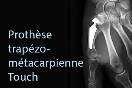 Prothèse trapézo-métacarpienne Touch