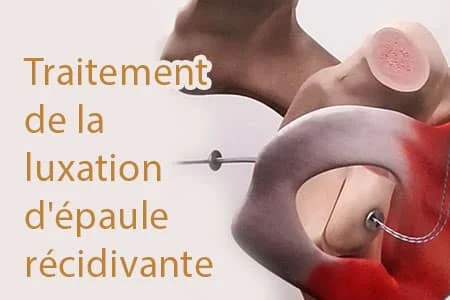 Traitement de la luxation d&rsquo;épaule récidivante