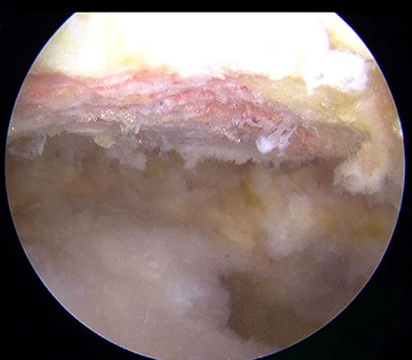 Vue de l'acromion après acromioplastie