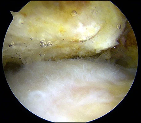 Vision sous arthroscopie du conflit