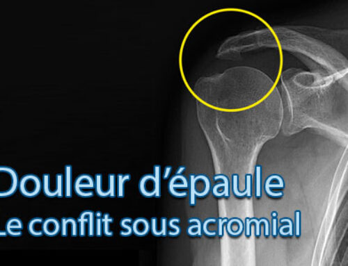 Le conflit sous acromial