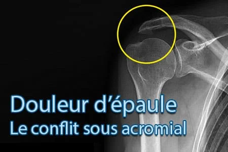Le conflit sous acromial