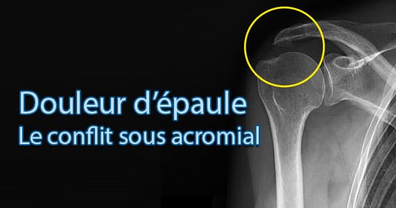 Acromioplastie convalescence