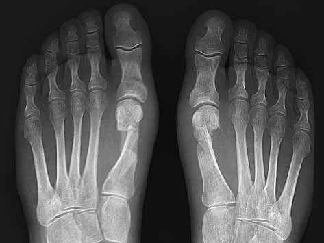 hallux-valgus-apres-2