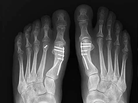 hallux-valgus-apres-3