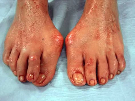 hallux-valgus-avant
