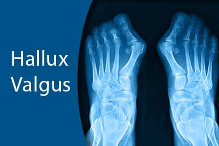 thumb-hallux-valgus