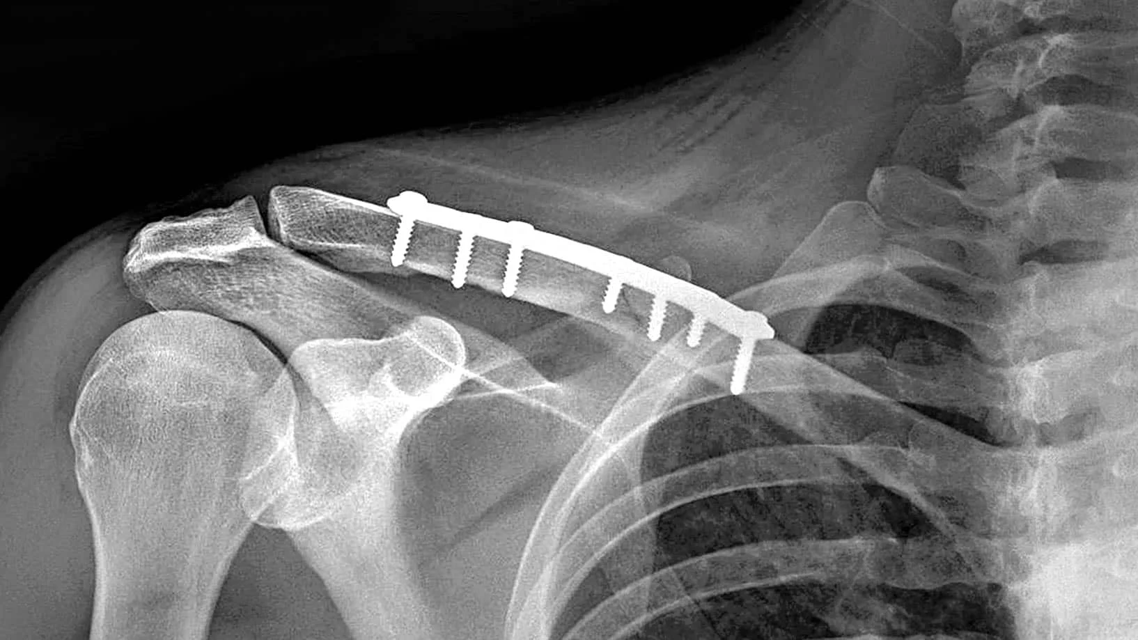 fracture-clavicule-apres